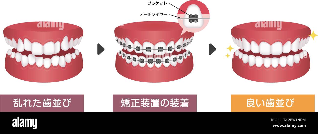 Dental braces process vector illustration / Japanese Stock Vector Image