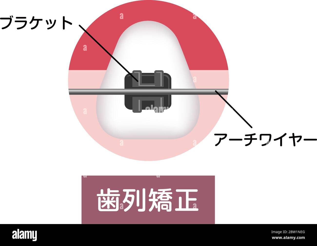 Dental braces vector illustration / Japanese Stock Vector Image & Art