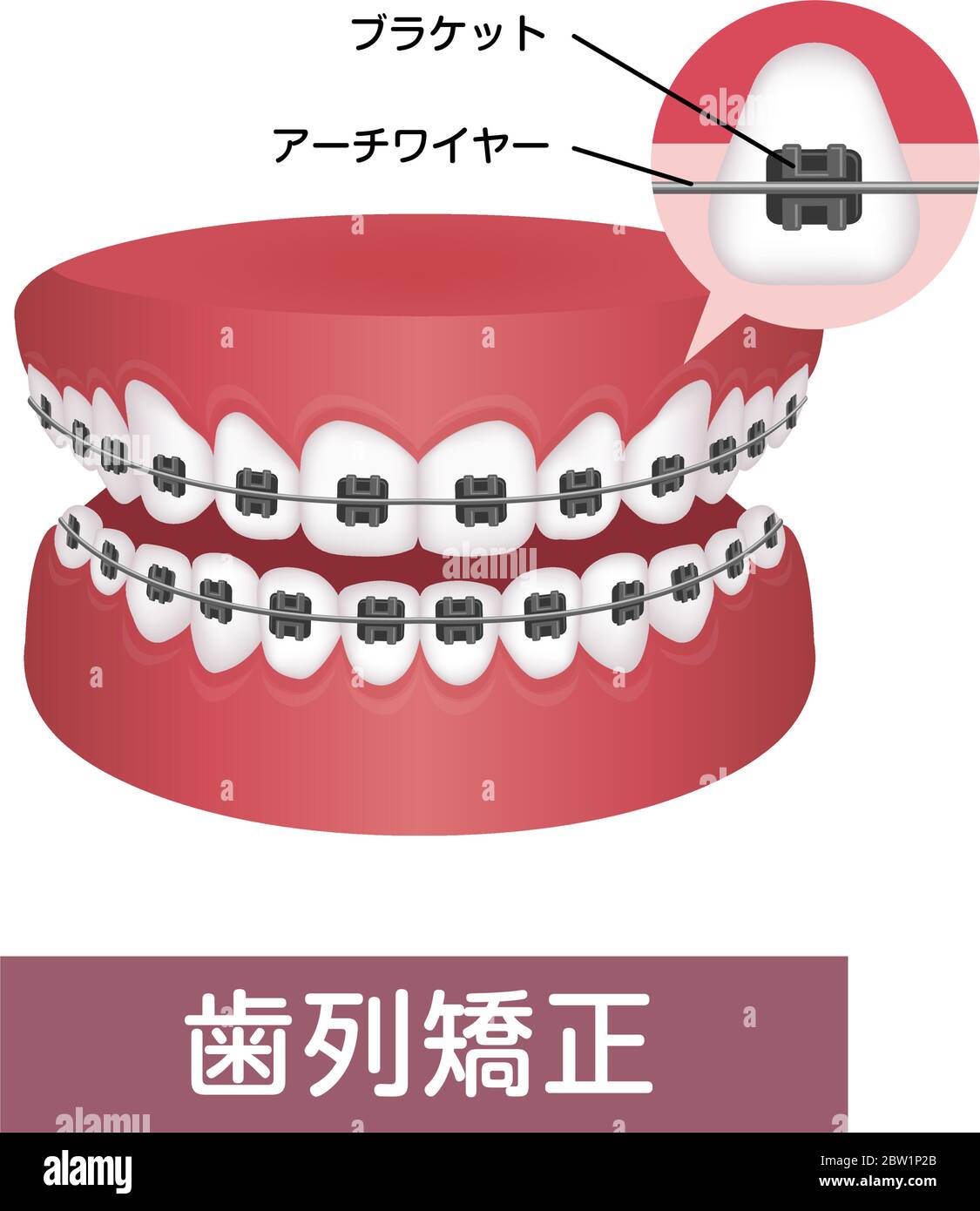 Dental braces vector illustration / Japanese Stock Vector Image & Art