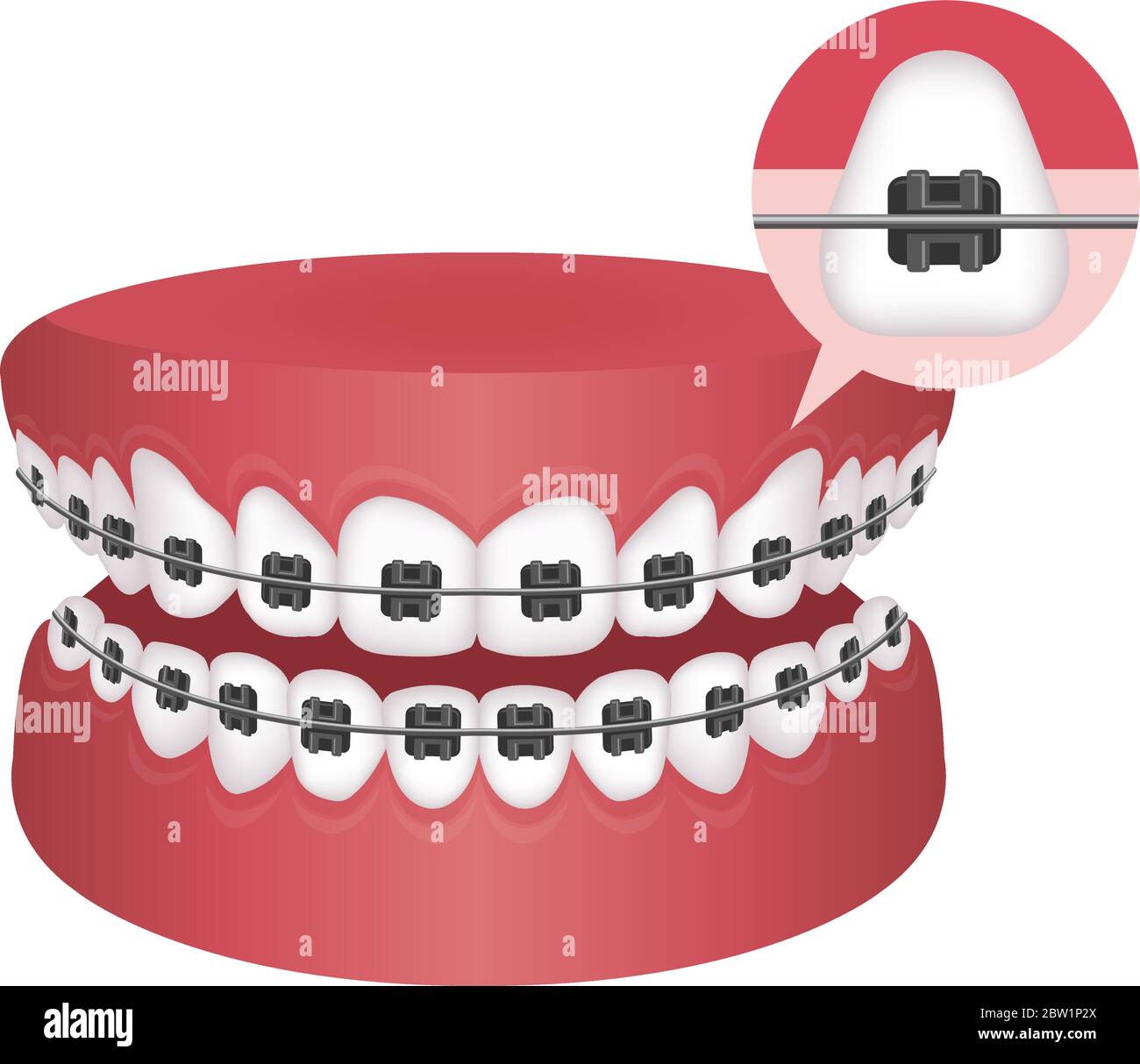 Dental braces flat vector illustration / no text Stock Vector Image