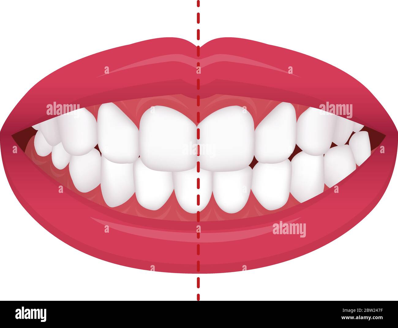 Teeth trouble ( bite type / crooked teeth ) vector illustration ...