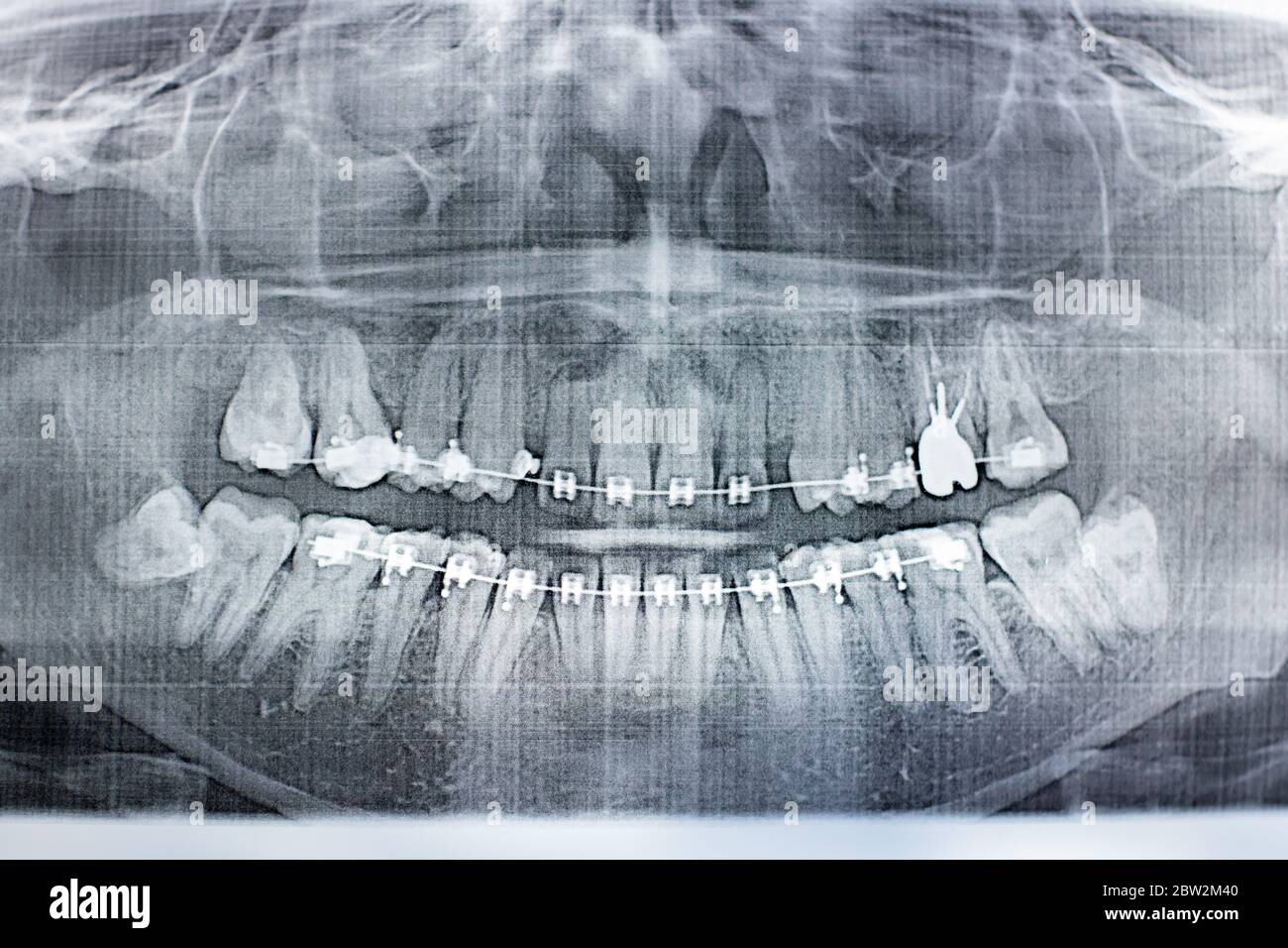 Wisdom tooth ray hi-res stock photography and images - Page 2 - Alamy
