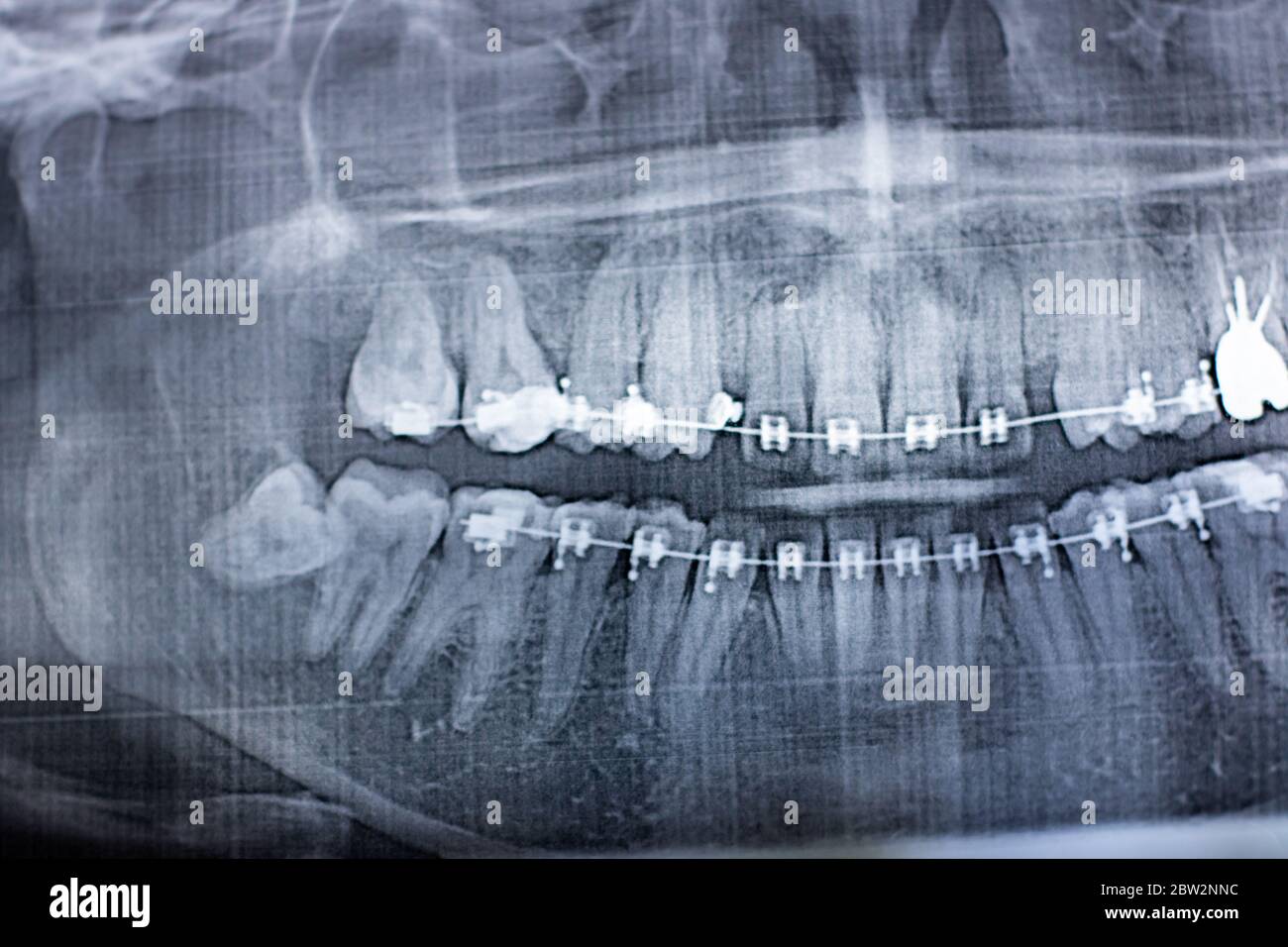 X-ray photograph of human teeth with a braces system. Retarded Wisdom Tooth Stock Photo