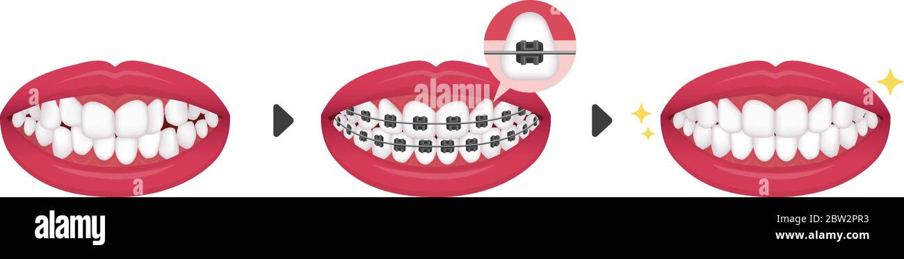 Dental braces process vector illustration / no text Stock Vector Image ...
