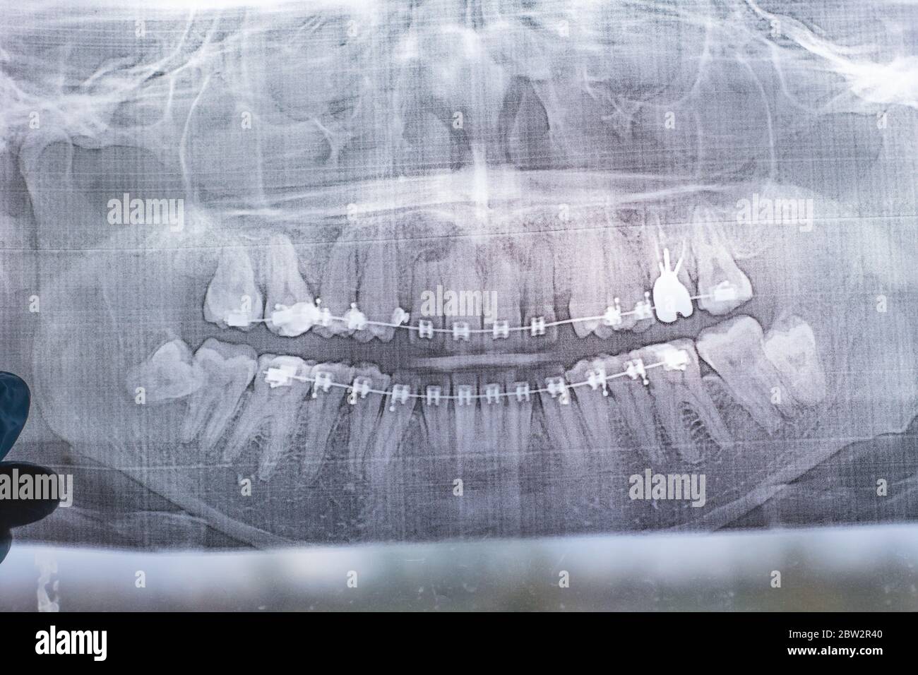 X-ray photograph of human teeth with a braces system. Retarded Wisdom Tooth Stock Photo