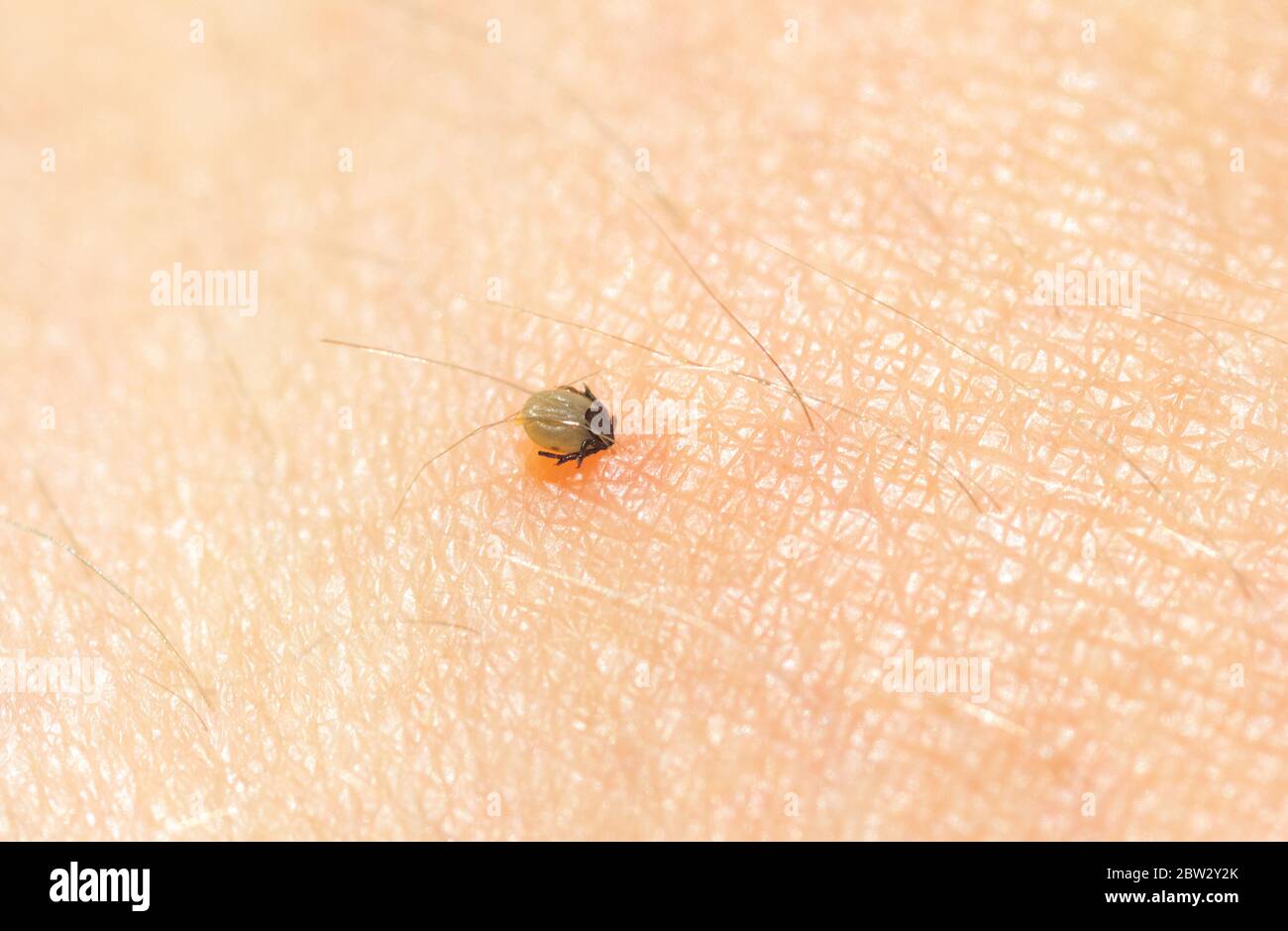Little Ixodes ricinus bug on human skin suck blood. Tick insect ...