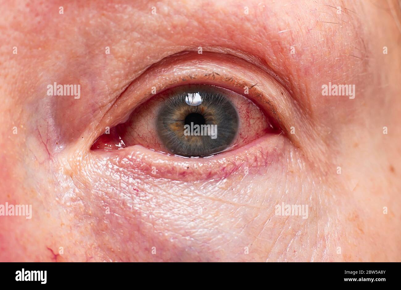 Eye of a woman with severe redness and hemorrhage in the eye coronovirus. Close-up Macro. Ophthalmic eye problems. An allergic reaction is irritation Stock Photo