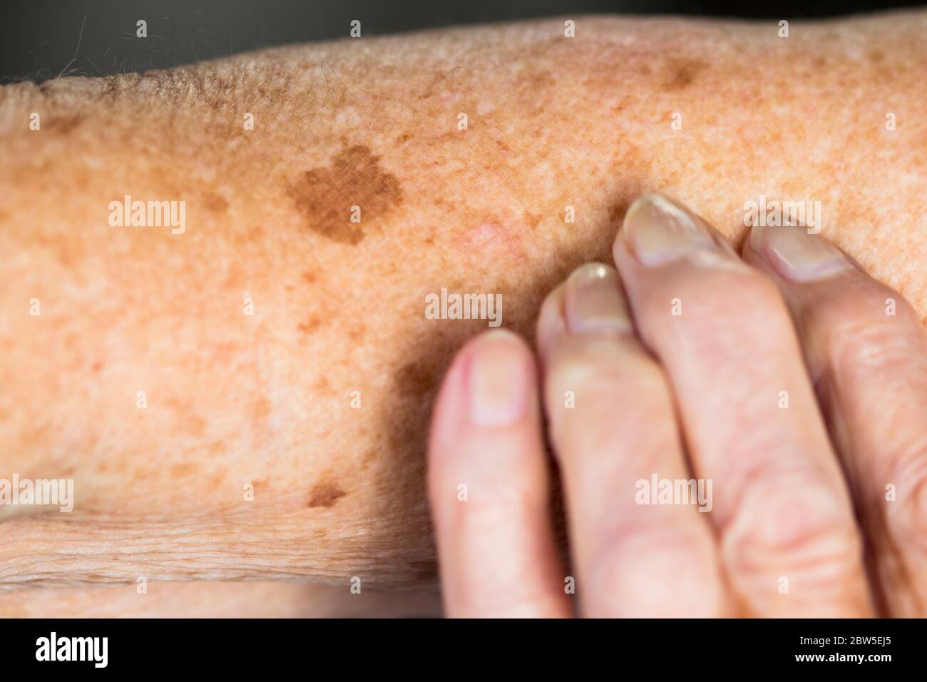 Liver Spots High Resolution Stock Photography And Images Alamy Liver Spots High Resolution Stock Photography And Images Alamy