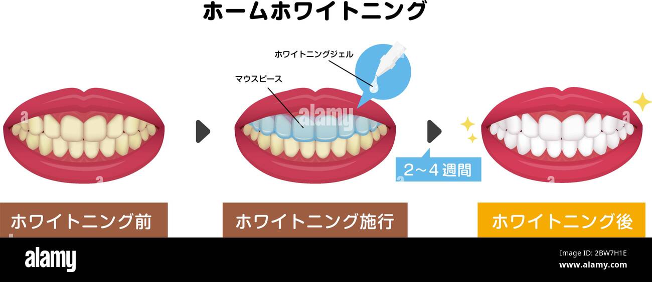 Teeth whitening vector illustration / before and after (Japanese Stock