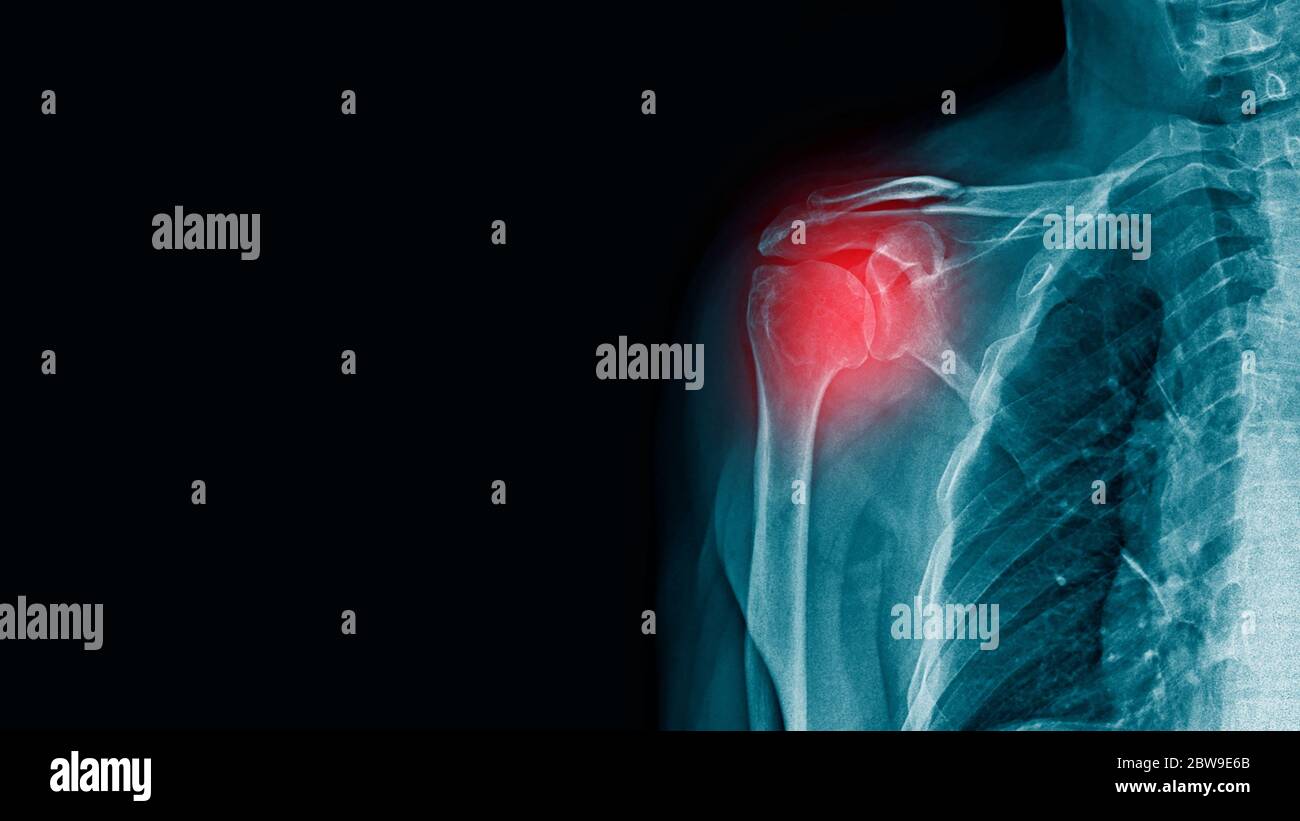 xray image of shoulder with scapular fracture Stock Photo Alamy