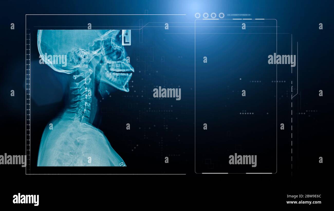 Cervical spine hi-res stock photography and images - Alamy