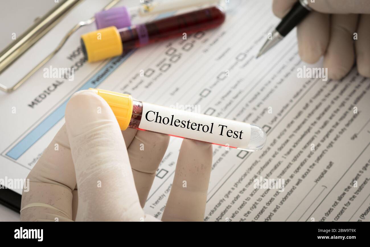 Doctor holding sample blood collection tube with cholesterol test label. Stock Photo