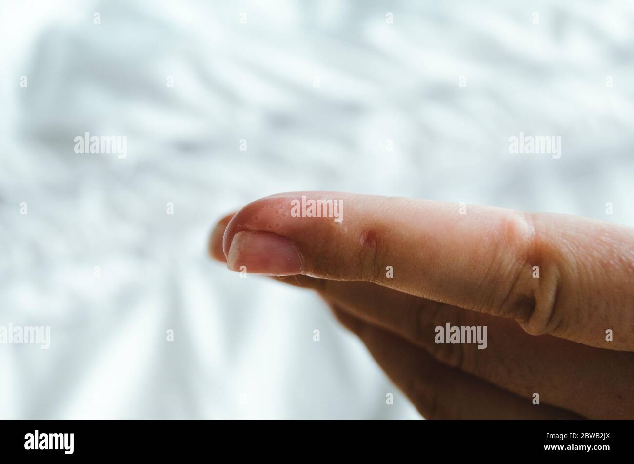 Closeup of the index finger drying up from dyshidrosis Stock Photo Alamy
