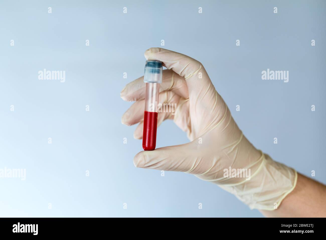 Test tube with a blood sample in the hands of a nurse. Blood test for
