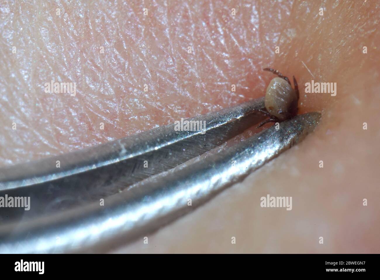 Super close up of sucking tick (Ixodes ricinus) removal with steel