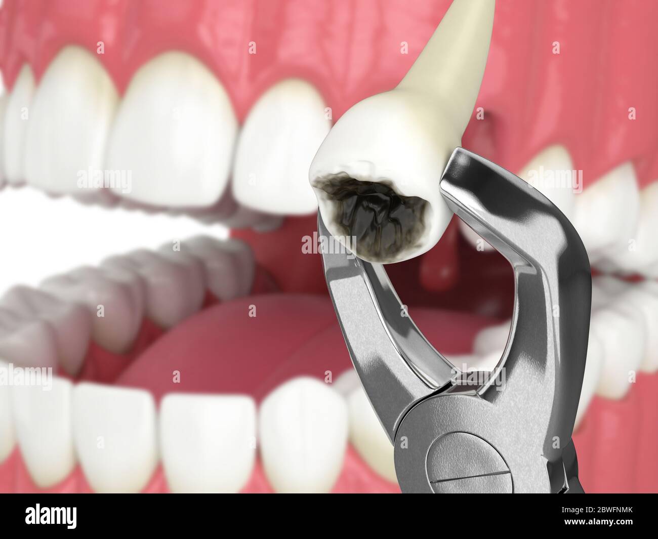 Tooth Forcedps 3d render of dental forceps with extracted tooth Stock Photo - Alamy