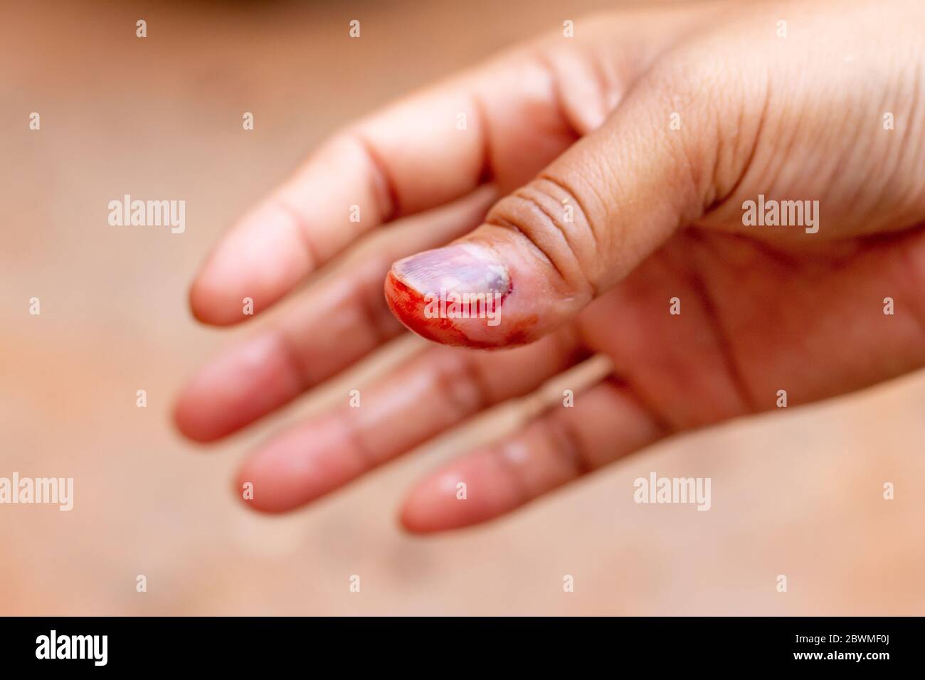 Injury to the right hand nail and bleeding to the right thumb And causing bleeding in the fingernail Stock Photo