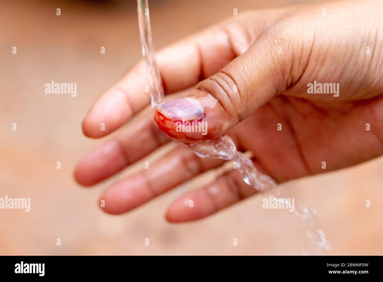 The saline solution is poured over the human finger with black nails, bruised with blood. Stock Photo