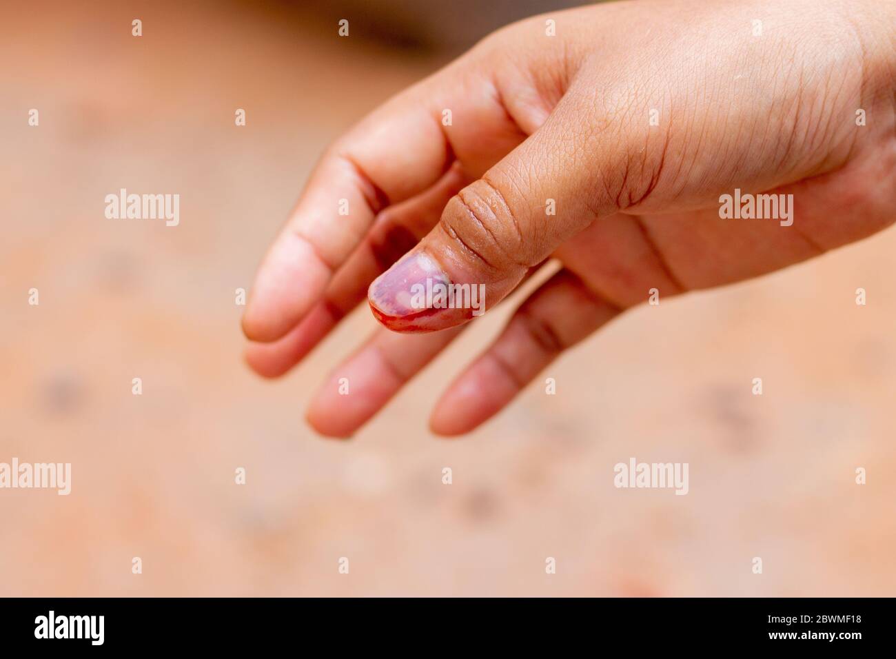 Small wound on the finger, fresh blood after injury, close up, bleeding  Stock Photo - Alamy