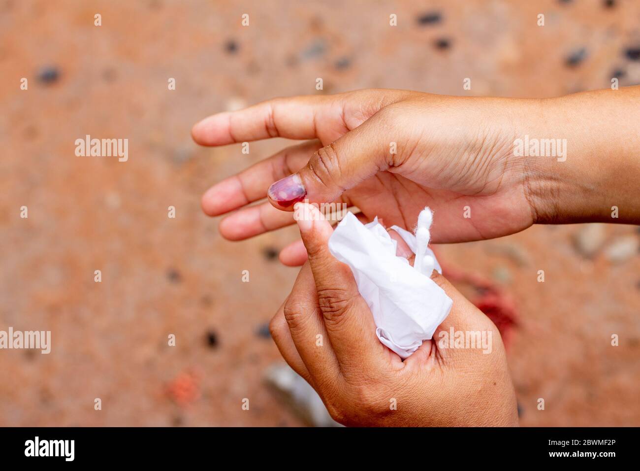Injury to the right hand nail and bleeding to the right thumb And causing  bleeding in the fingernail 13685224 Stock Photo at Vecteezy