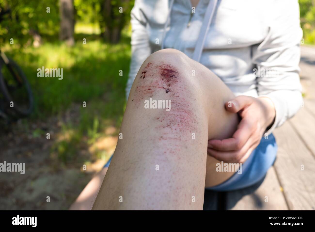 Injury to the legs during outdoor activities, jogging, cycling. An open,  bleeding wound to the leg with peeled skin, bruises and bruises. Accident  Stock Photo - Alamy