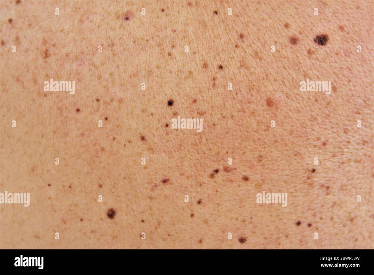 A lot of birthmark and moles on skin texture background photo Stock Photo