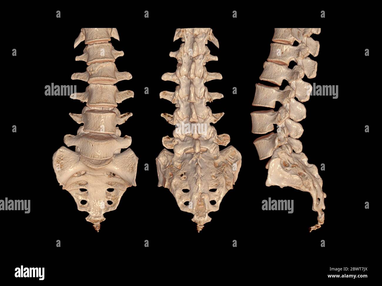 Collection of CT Lumbar or L-S spine 3D rendering image Front , back and Lateral view showing Compression fractures at L2. 3D illustration. Stock Photo
