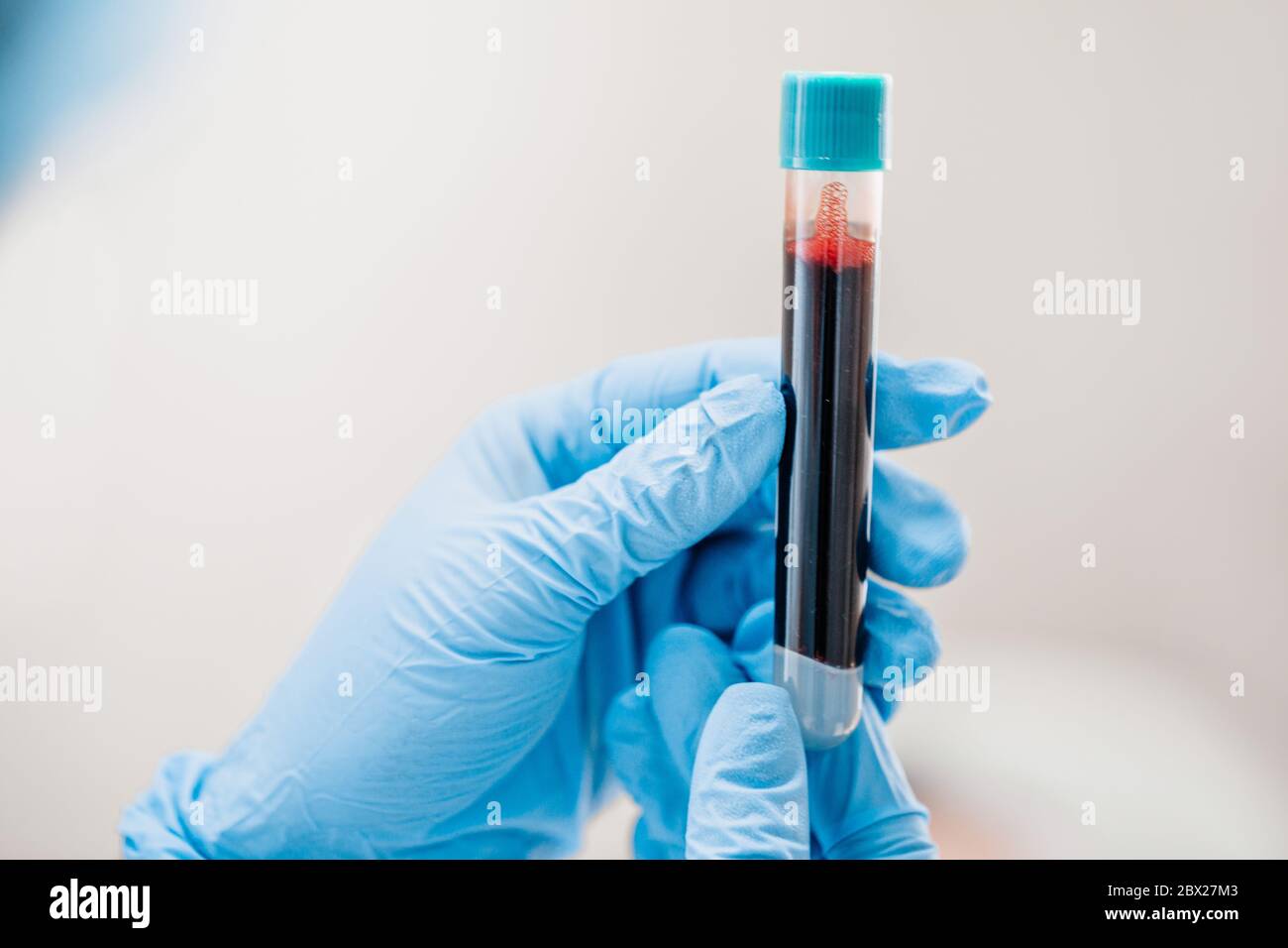 Plasma lifting - Closeup of doctor's hand with test tube with blood - analysis and diagnosis Stock Photo