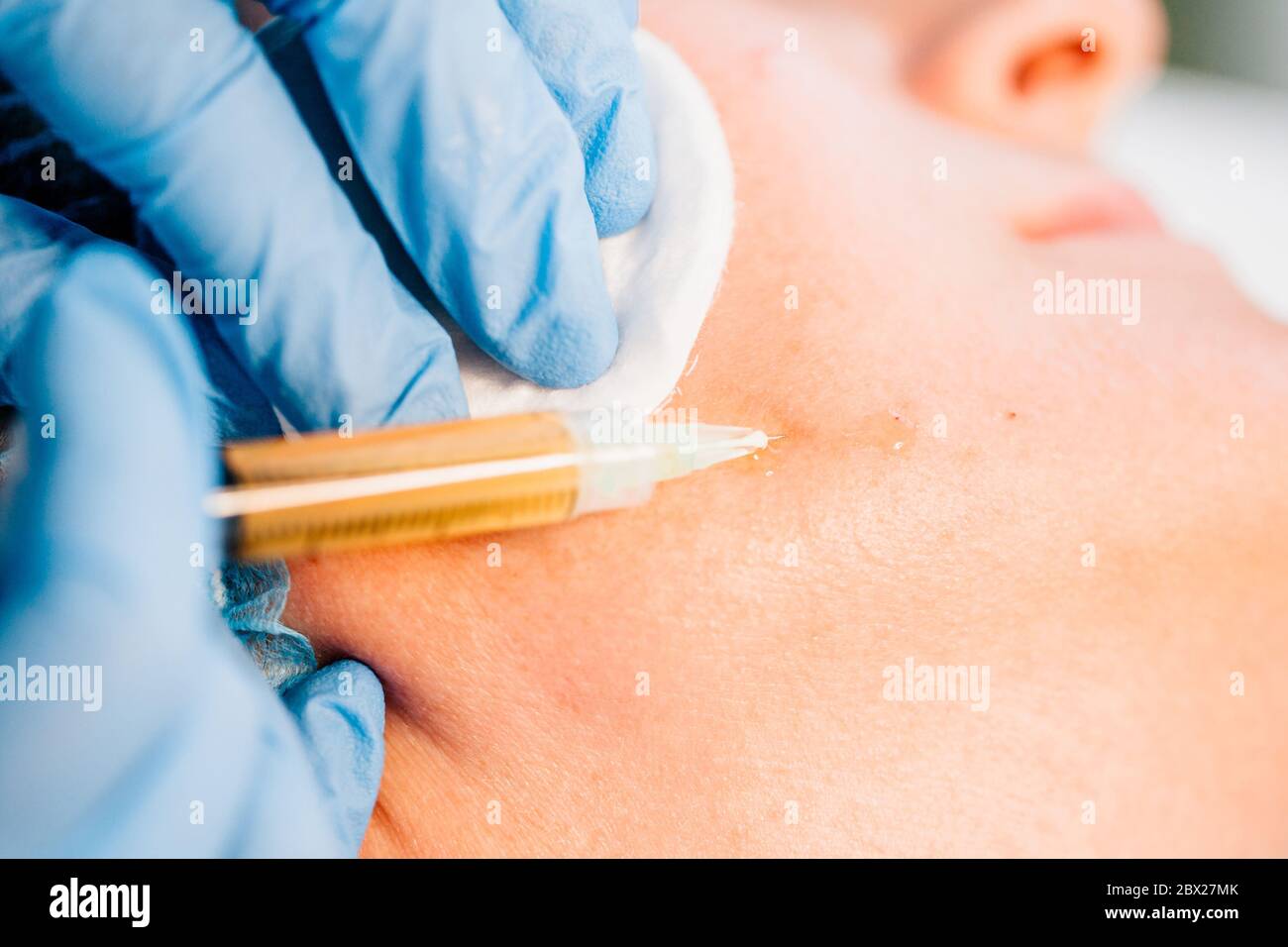 Plasma lifting - injections of blood plasma into the skin in the lower ...