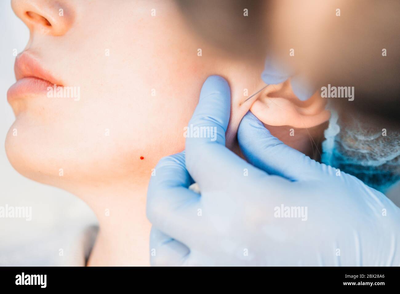 The procedure for the introduction of the active substance - under the skin, in pre-marked areas, injections of gualuronic acid are made - an ultrafin Stock Photo