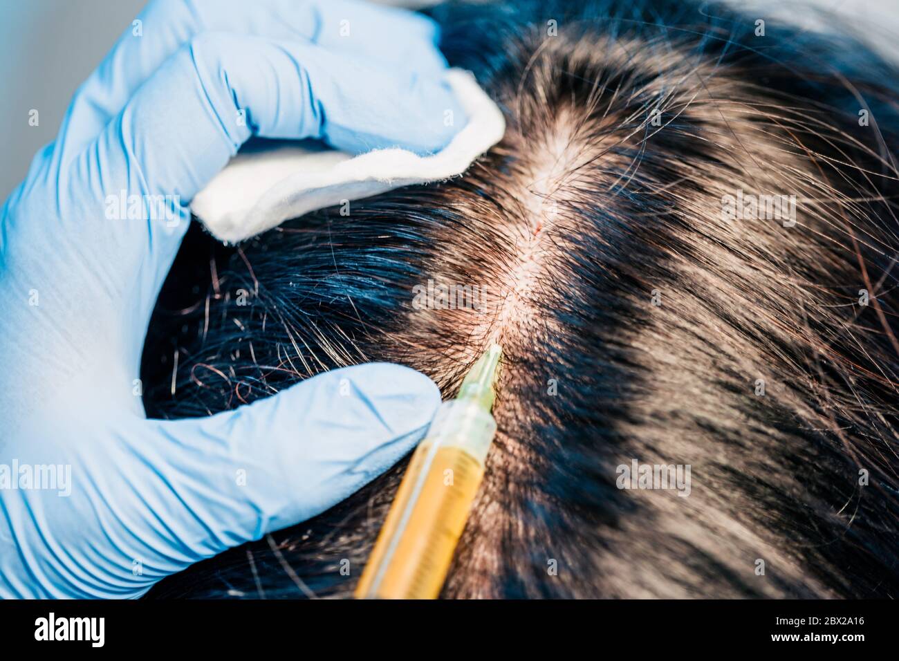 Hair transplantation - hair follicle transplantation - treatment of baldness and strengthening the scalp Stock Photo