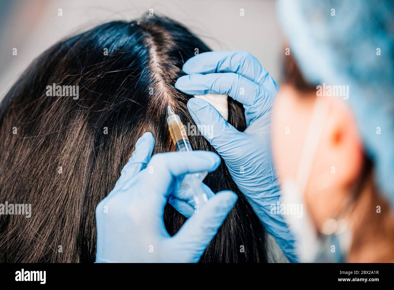 Hair transplantation - hair follicle transplantation - treatment of baldness and strengthening the scalp Stock Photo