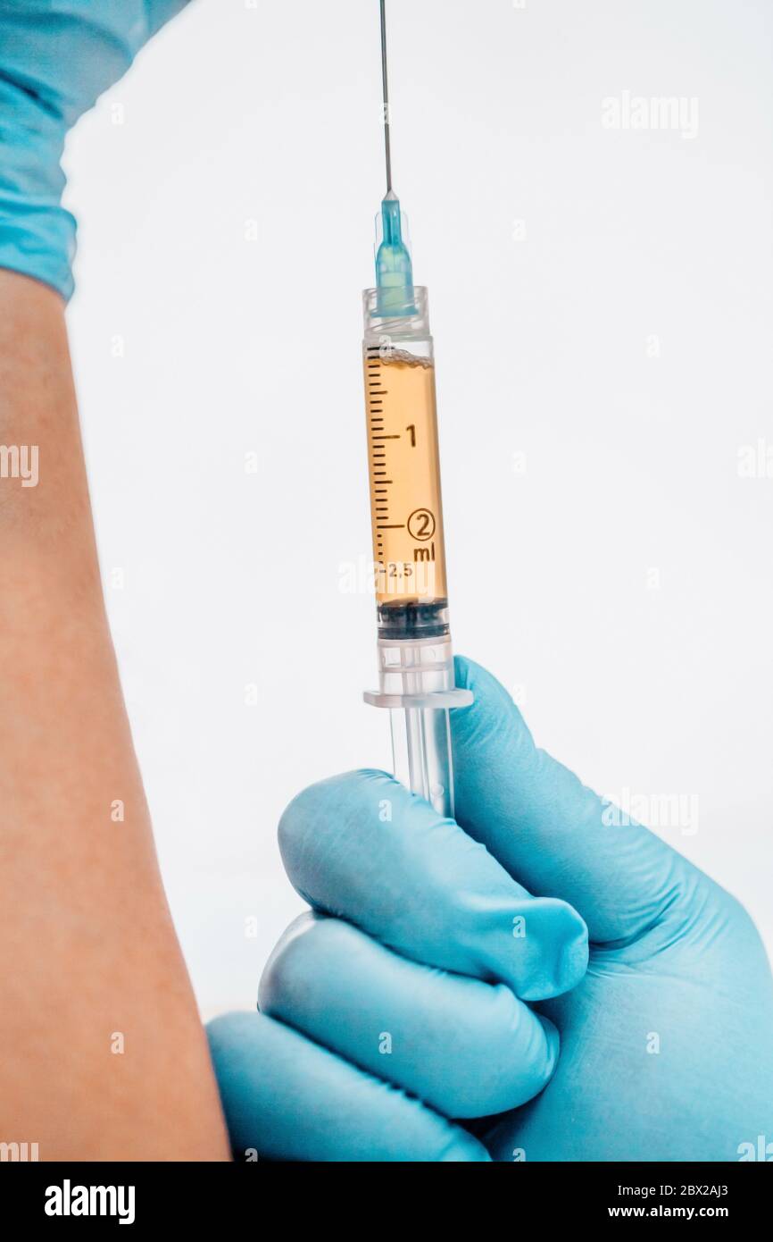 Vertical image format - Plasma lifting - close-up syringe with plasma in doctor's hands Stock Photo