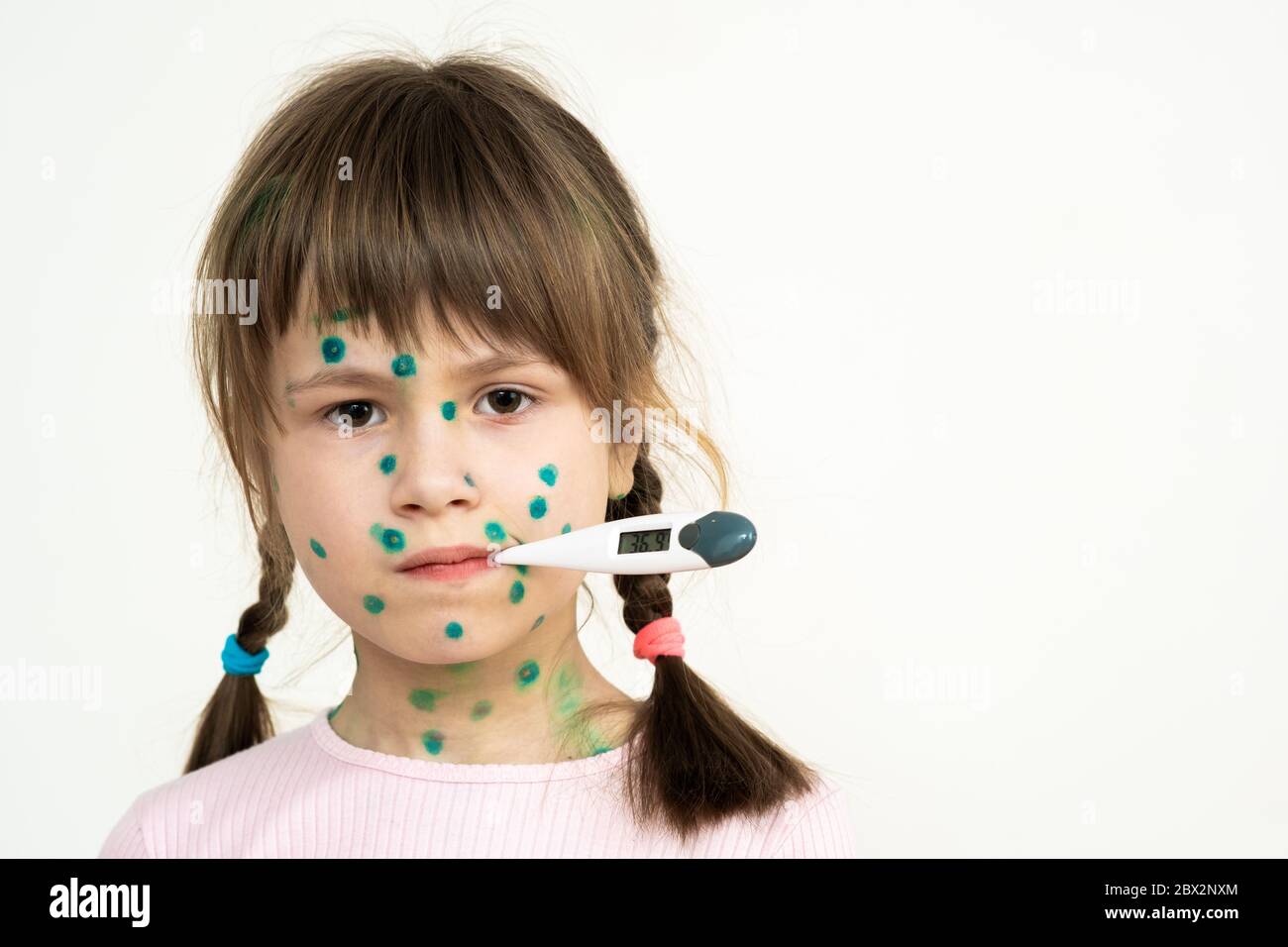 Child girl covered with green rashes on face ill with chickenpox, measles or rubella virus holding medical thermometer in her mouth having high temper Stock Photo