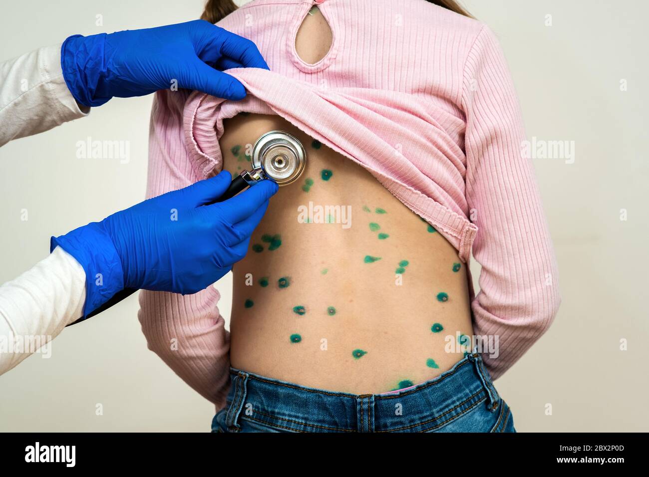 Doctor examining a child with stethoscope covered with green rashes on back ill with chickenpox, measles or rubella virus. Stock Photo