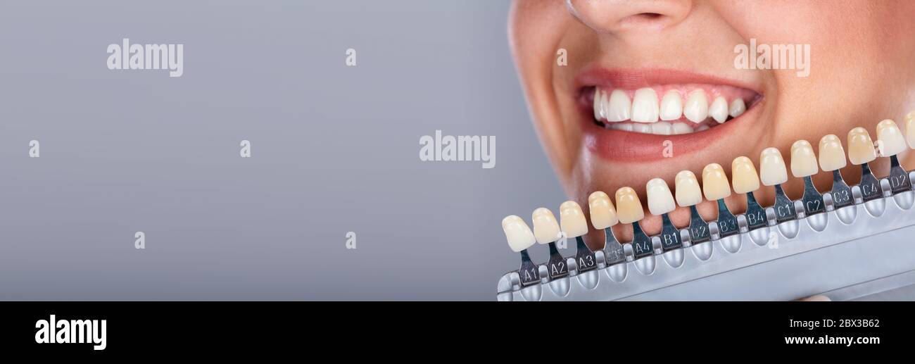 Stomatology Teeth Gap And Dental Implant. Tooth Shade Stock Photo