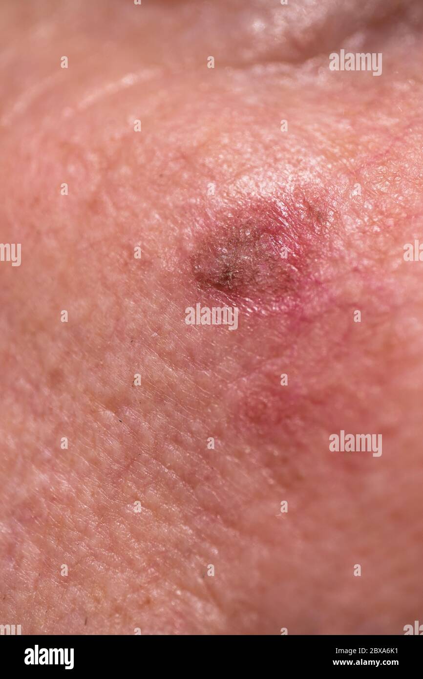 Close up of red crusty lesions of actinic keratosis or sunspots on sun-damaged skin on the cheek under the right eye of a man Stock Photo