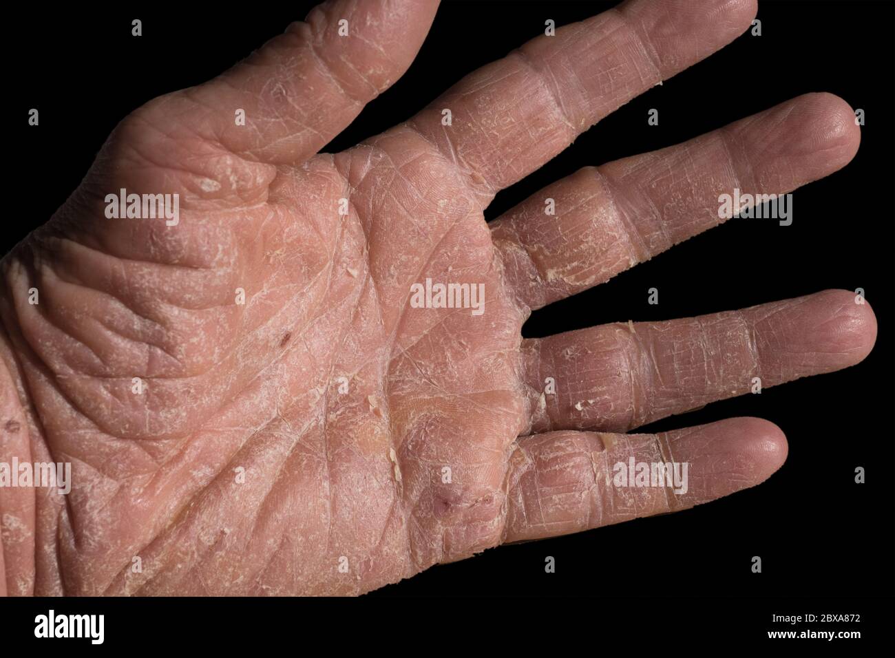 Eczema with redness, swellings, bumps and flakes on the hand and fingers of a man. Isolated on black Stock Photo