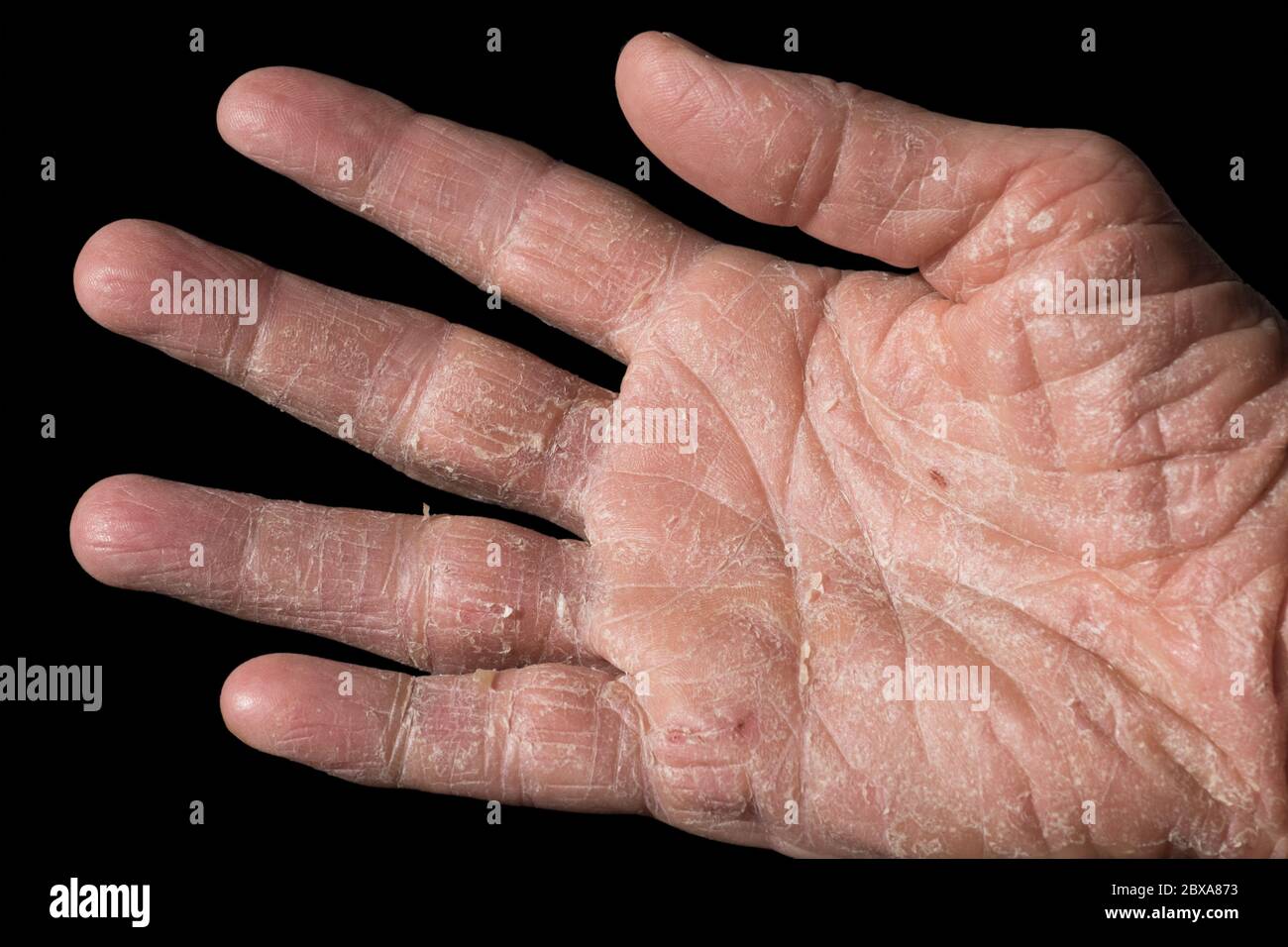 Eczema with redness, swellings, bumps and flakes on the hand and fingers of a man, caused by sun, atopy or contact allergens. Isolated on white Stock Photo