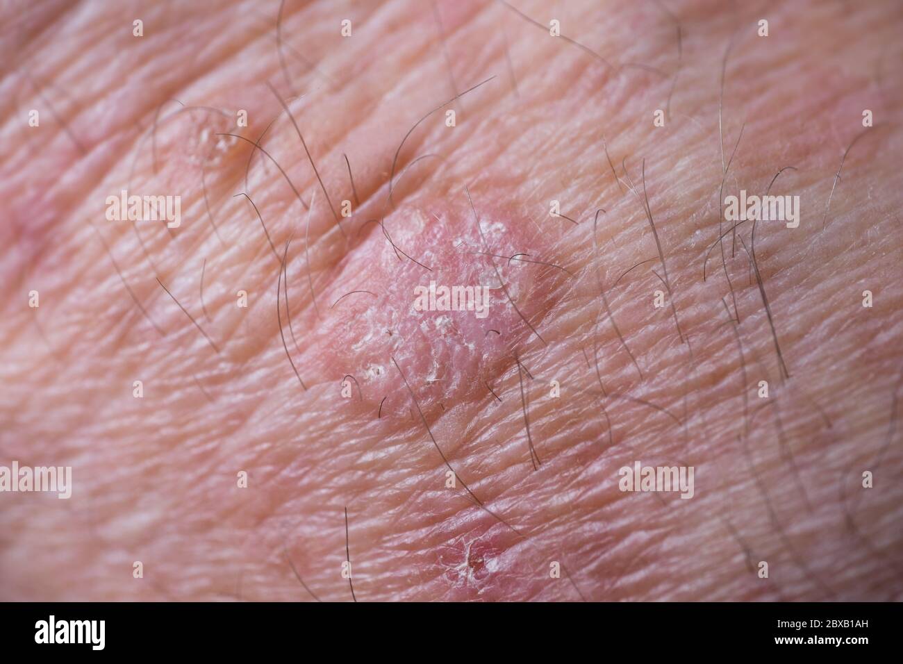 Crude eczema with redness, swellings, bumps and flakes on the wrist of a man. This can be treated with cryosurgery or certain ointments Stock Photo
