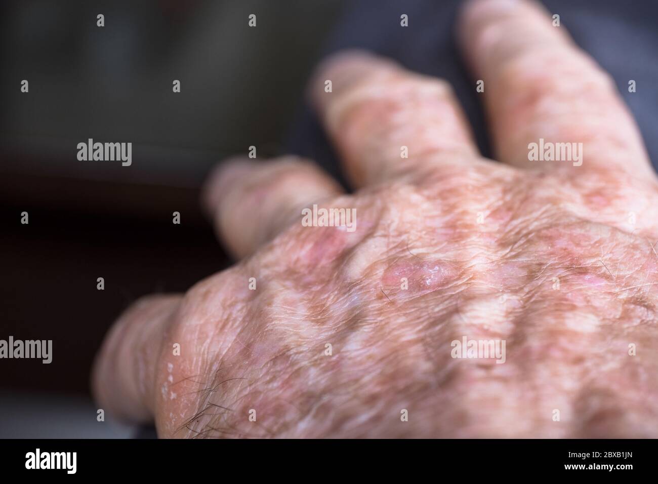 Lesions of actinic keratosis or sunspots on sun-damaged skin of the hand of a man. This can be treated with cryosurgery or certain ointments Stock Photo