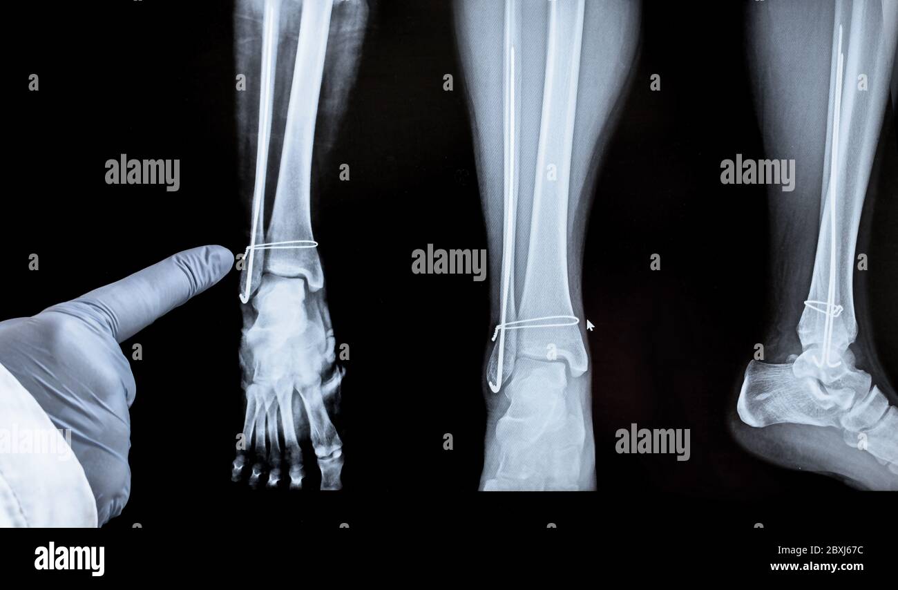X-ray of the leg after surgery - wires in the leg. The doctor points a finger at the operated area. Stock Photo