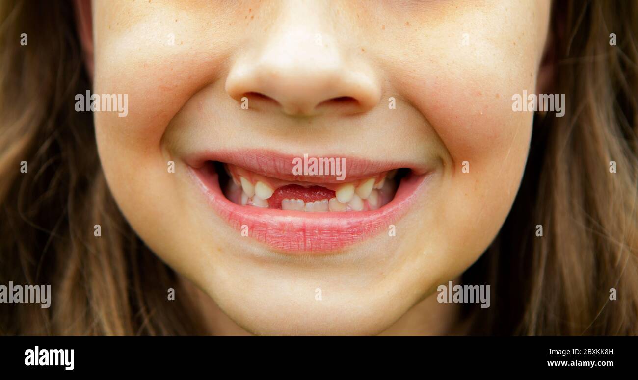 Smile with missing teeth hi-res stock photography and images - Alamy