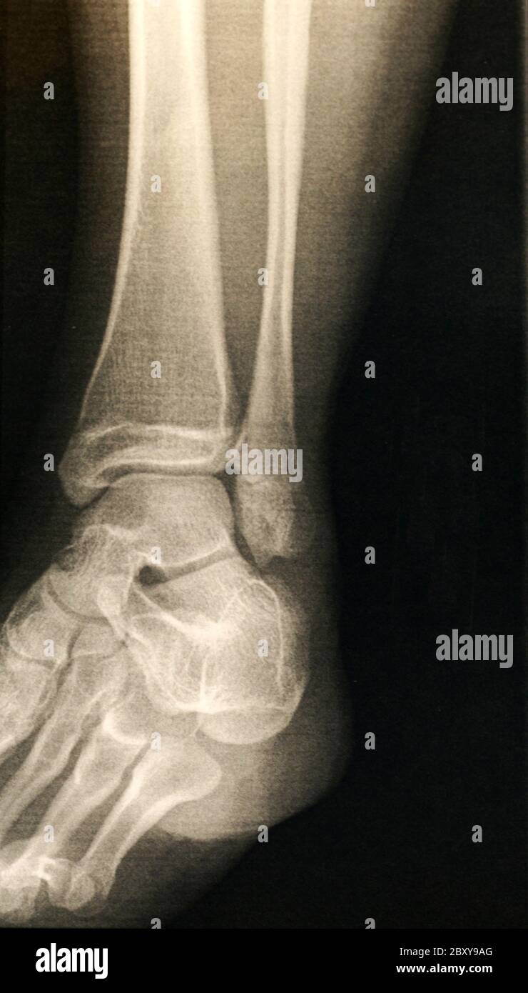A X-ray of a foot Stock Photo