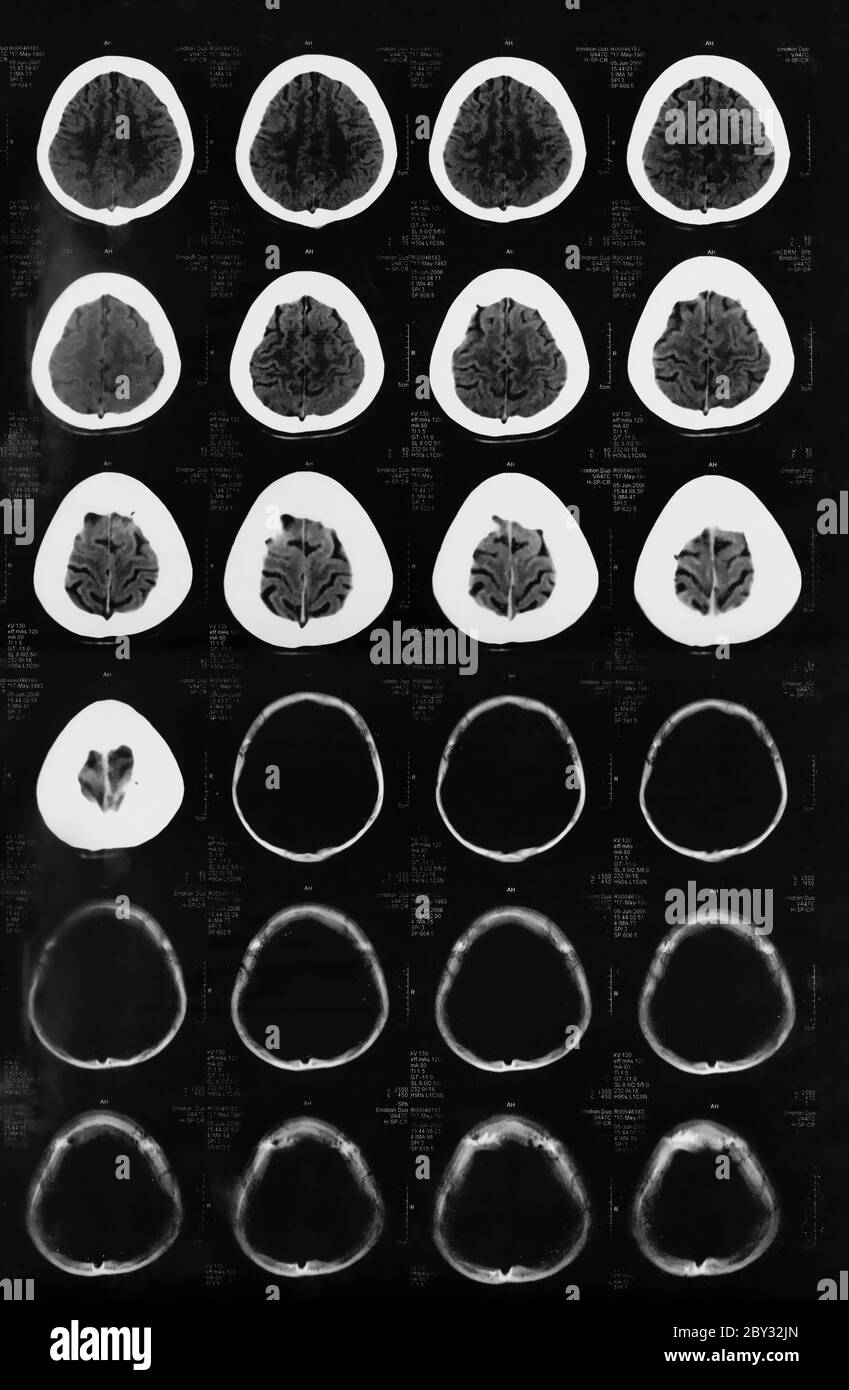 X-ray of the brain computed tomography Stock Photo - Alamy