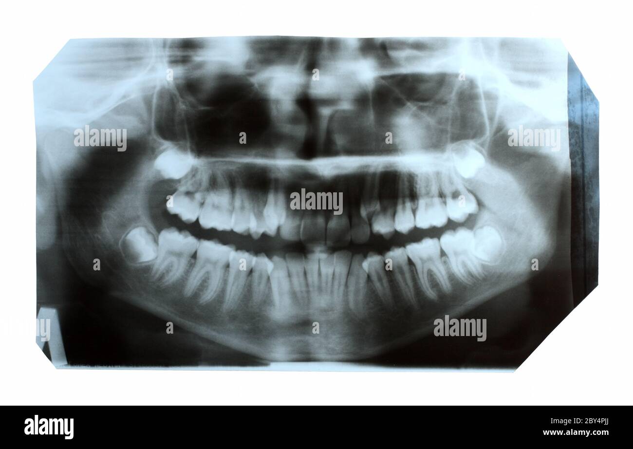 dental x-ray picture of jaw Stock Photo