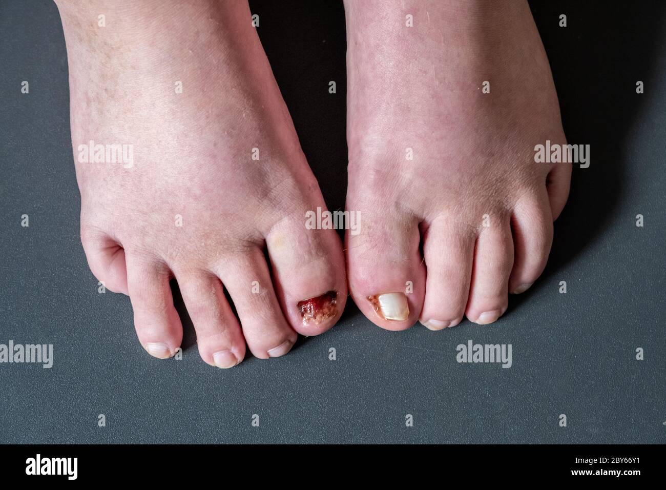Patient after a few days of healing showing toe with one toenail