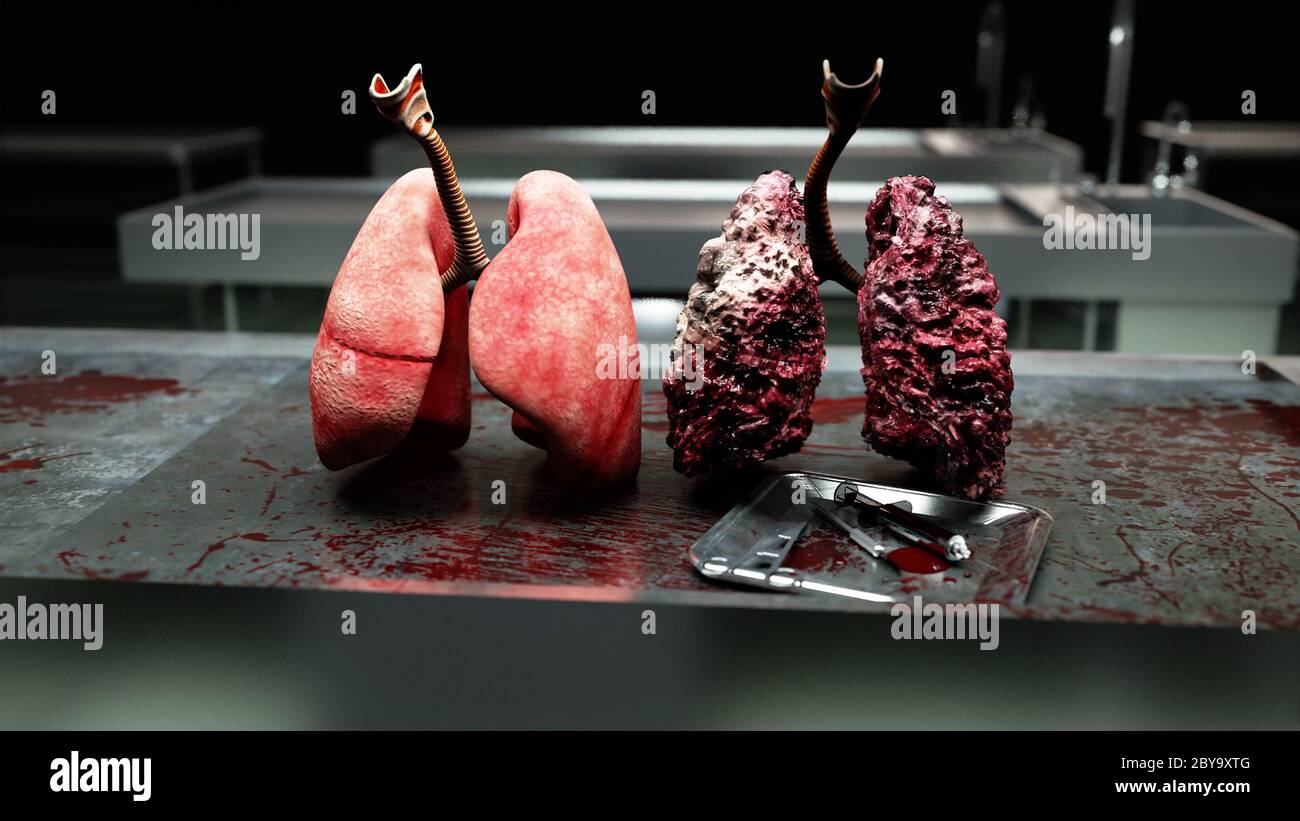 healthy lungs and disease lungs on morgue table. Autopsy medical concept. Cancer and smoking problem. 3d rendering Stock Photo