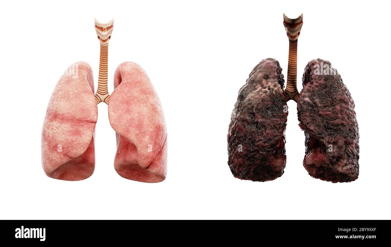 healthy lungs and disease lungs on white isolate. Autopsy medical concept. Cancer and smoking problem. 3d rendering Stock Photo
