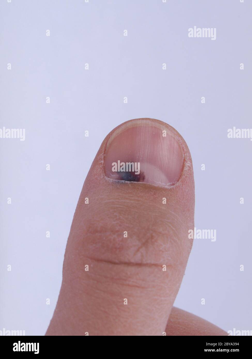 Subungual hematoma under nail Stock Photo Alamy